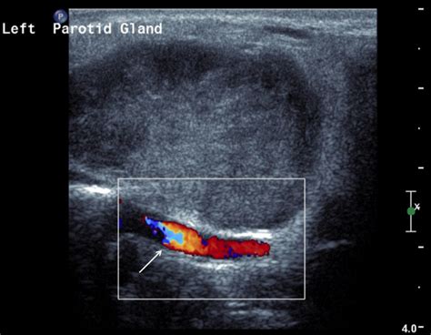 Parotid Duct Stone Ultrasound