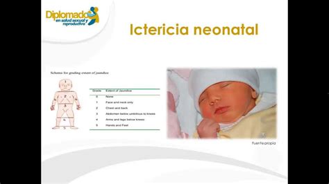 Ictericia Del Recien Nacido