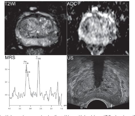 Figure From Magnetic Resonance Imagingdirected Biopsy Improves The