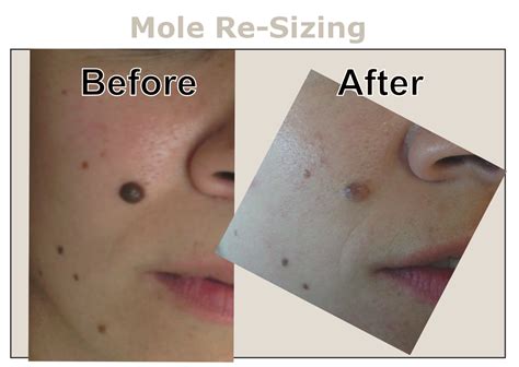 Mole Treatment Removal At Inskin Altrincham Manchester