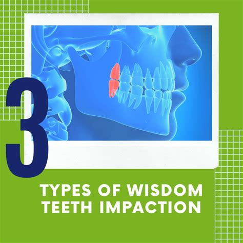 3 Types of Wisdom Teeth Impaction - Tulsa Precision Dental