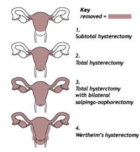 The undeniable benefits of a hysterectomy – Artofit 