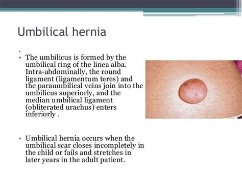 Ventral Hernias