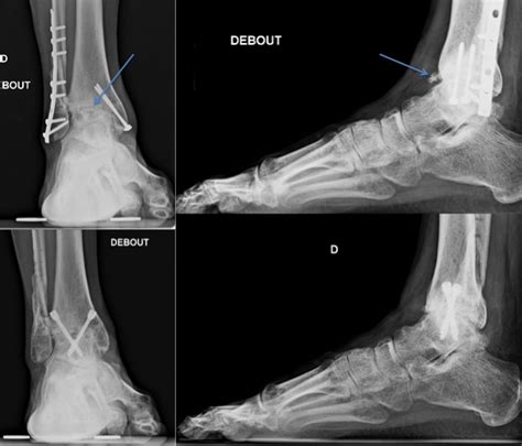 Arthrodesis – Foot and Ankle Institute