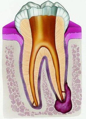 Гранулема зуба: как выявить, лечить и избежать | Полезные советы, Зубы ...
