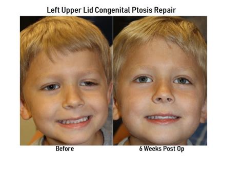 Eyelid Ptosis Treatment Austin | Drooping Eyelids | Dr. Amato