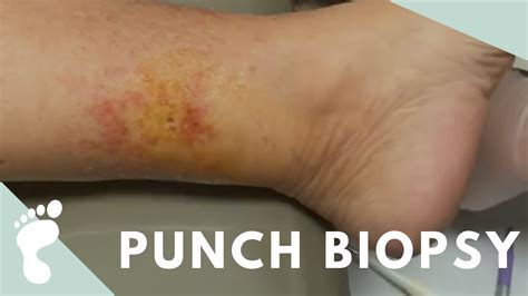 Punch Biopsy Youtube