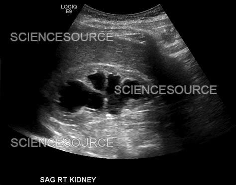 Hydronephrosis, ultrasound | Stock Image - Science Source Images