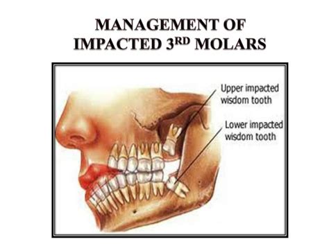 Third Molar Impaction Basic