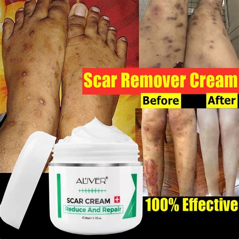 ALIVER Cream For Peklat 50ml Repair Skin Care Stretch Marks Burn