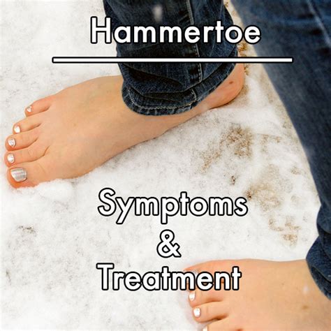 Hammertoe Symptoms and Treatment - Delray Beach Podiatry