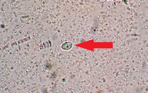 Trichomonas Vaginalis Clinical Feature Management Off