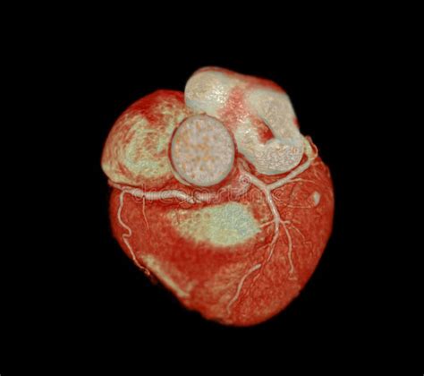 Ct Cardiac 3d Or Cta Coronary Artery Stock Illustration Illustration