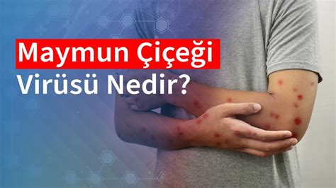 Maymun Çiçeği Virüsü Belirtileri Nelerdir Medical Park YouTube