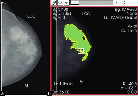 A Left Craniocaudal Mammogram Of A 41 Year Old Woman With A Negative