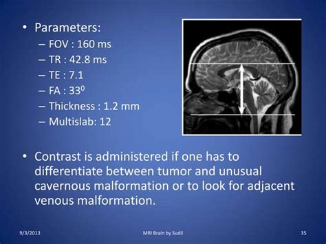 MRI Procedure of Brain | PPT