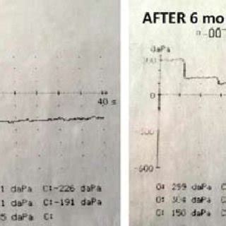 Inflation-deflation test result before and after tympanoplasty with... | Download Scientific Diagram