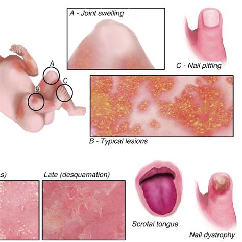 Cutaneous Signs Of Dira And Ditra A Dira Erythematous Plaques