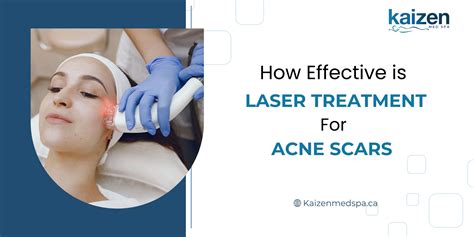 How Effective Is Laser Treatment For Acne Scars