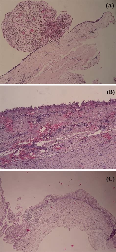 Photomicrograph Of An H And E Stained Sections Showing A Dentigerous