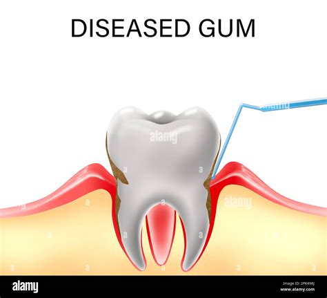 Infected Gum And Tooth Illustration Periodontal Disease Stock Photo