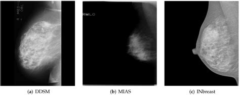 Mlo Mammography Positioning Angle