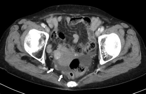 An Axial Enhanced Ct Image Showed A Thickened And Enhanced Peritoneum