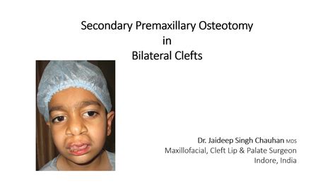 Secondary Premaxillary Osteotomy In Bilateral Clefts Dr Jaideep Singh