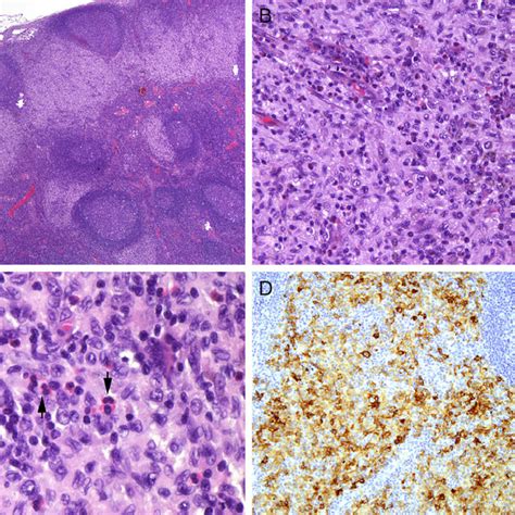 A Lymph Nodes Affected By Langerhans Cell Histiocytosis Download Scientific Diagram