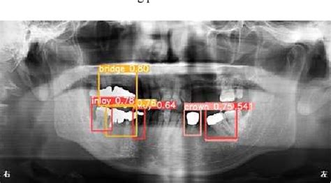 Figure 8 From Tooth Recognition In X Ray Dental Panoramic Images With Prosthetic Detection