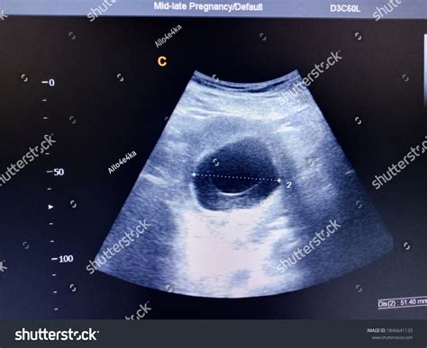 Blighted Ovum By Ultrasound Scan Stock Photo 1846641133 Shutterstock