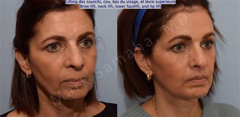 Lifting Du Visage Cou Facelift Necklift Avant Apr S Photos