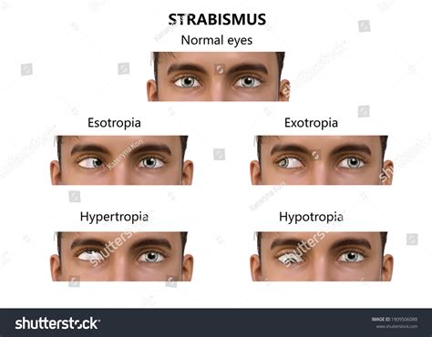 Strabismus 3d Illustration Showing Different Types Stock Illustration 1909506088 | Shutterstock