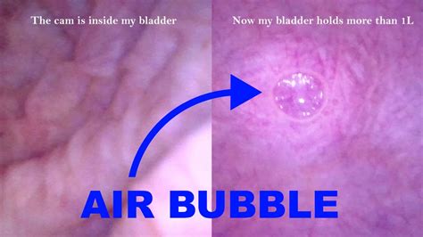 Pov Endoscope Catheter Bladder Inflation Austrian Shemale Amateur Porn Xhamster