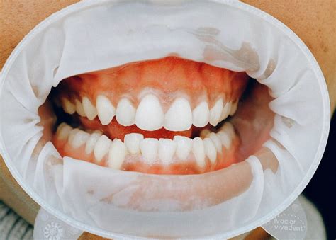 What Is Vagina Dentata SexXnet