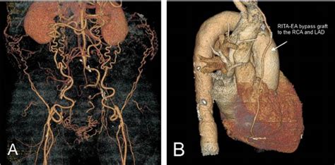 The Preoperative And Postoperative 3d Reconstruction From Ct Scan A Download Scientific