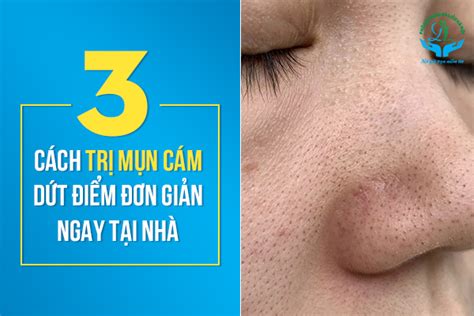 3 Cách Trị Mụn Cám Dứt Điểm Đơn Giản Ngay Tại Nhà Phòng Khám Da Liễu