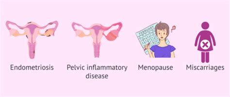 Causes Of Retroverted Uterus