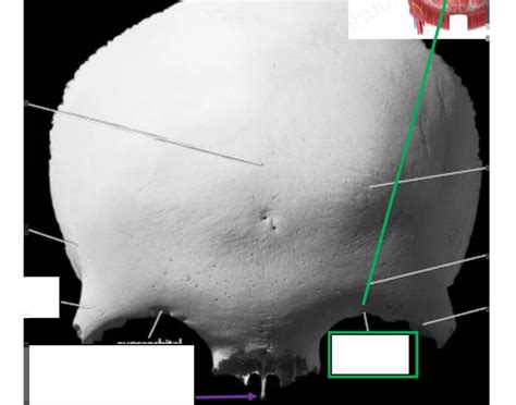 Frontal Bone Anatomy Quiz