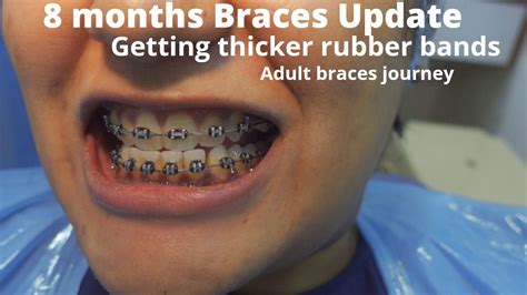 8 Month Braces Journey Update