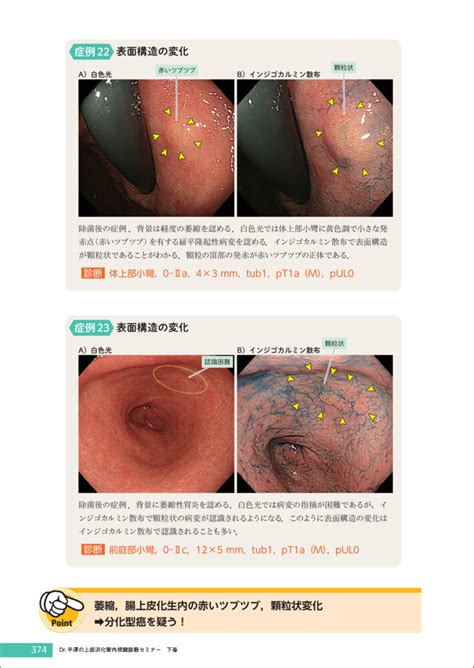 Dr 平澤の上部消化管内視鏡診断セミナー 下巻〜がんを見逃さないための観察と病変拾い上げのコツ 羊土社