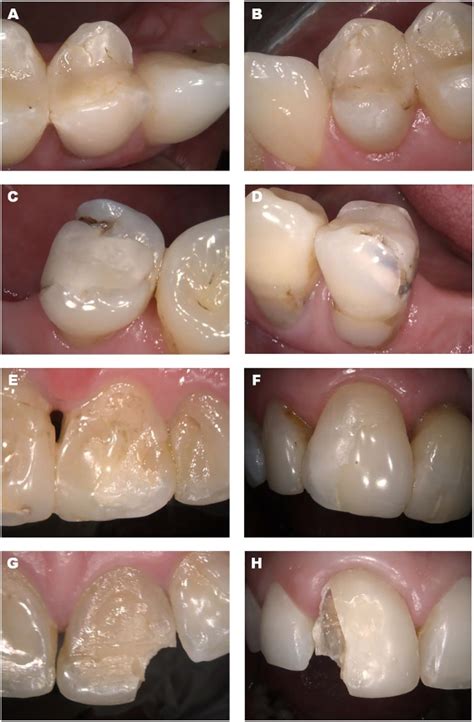 Validation Of Assessment Of Intraoral Digital Photography For Evaluation Of Dental Restorations