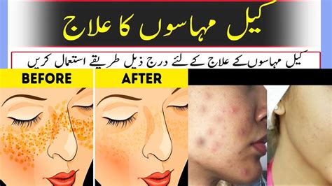 How To Get Rid Of Acne Marks On Face Chehre Ke Daag Dhabe Hatane Ke