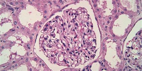 Understanding Glomerulonephritis: Causes, Symptoms, And Diagnosis - SKI