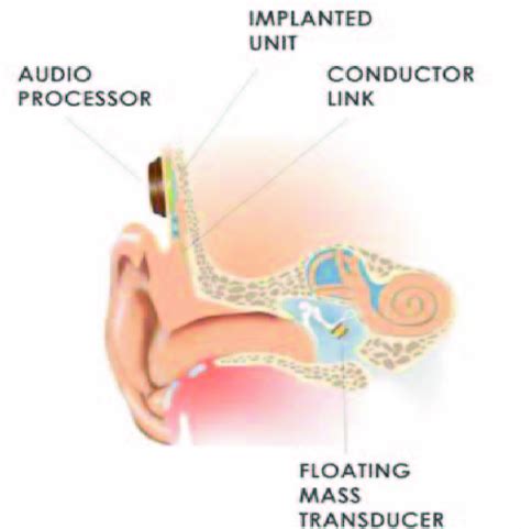 A diagram of an ear with a middle-ear implant. Reproduced with ...