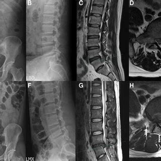 Two patients with lumbosacral transitional vertebrae. (a-d) A ...