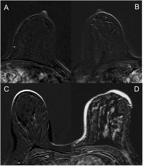 Motion Artifacts Lesion Type And Parenchymal Enhancement In Breast