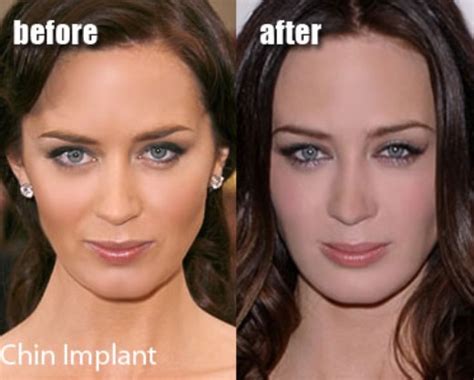 Emily Blunt Plastic Surgery Before and After Chin Implants, Cheek and ...