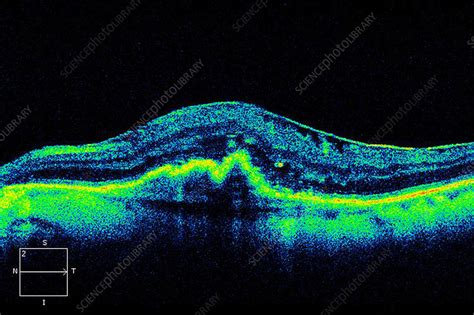 Macular degeneration, OCT scan - Stock Image - C024/0948 - Science ...