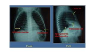 Bronquiolitis En Pediatr A Para Principiantes Ppt